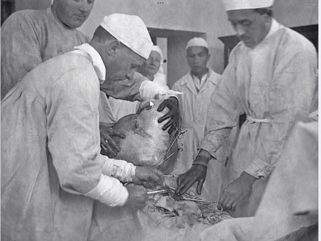 Swedish missionaries removing a tumor from the stomach of a Uyghur patient.