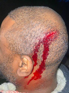 An AROPL member injured during the mob attacks against the religion’s headquarters in Crewe, UK.